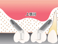傾斜埋入