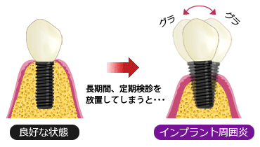 長期間、定期検診を放置してしまうと....