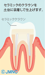 セラミックのクラウンを土台に装着して仕上げます。